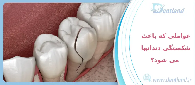انواع شکستگی دندان